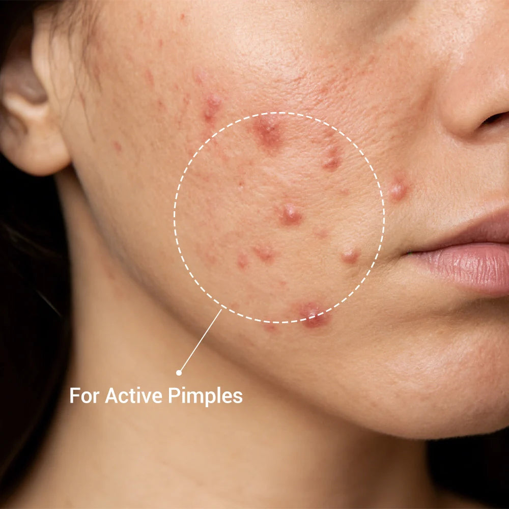 Pimple Drying Lotion